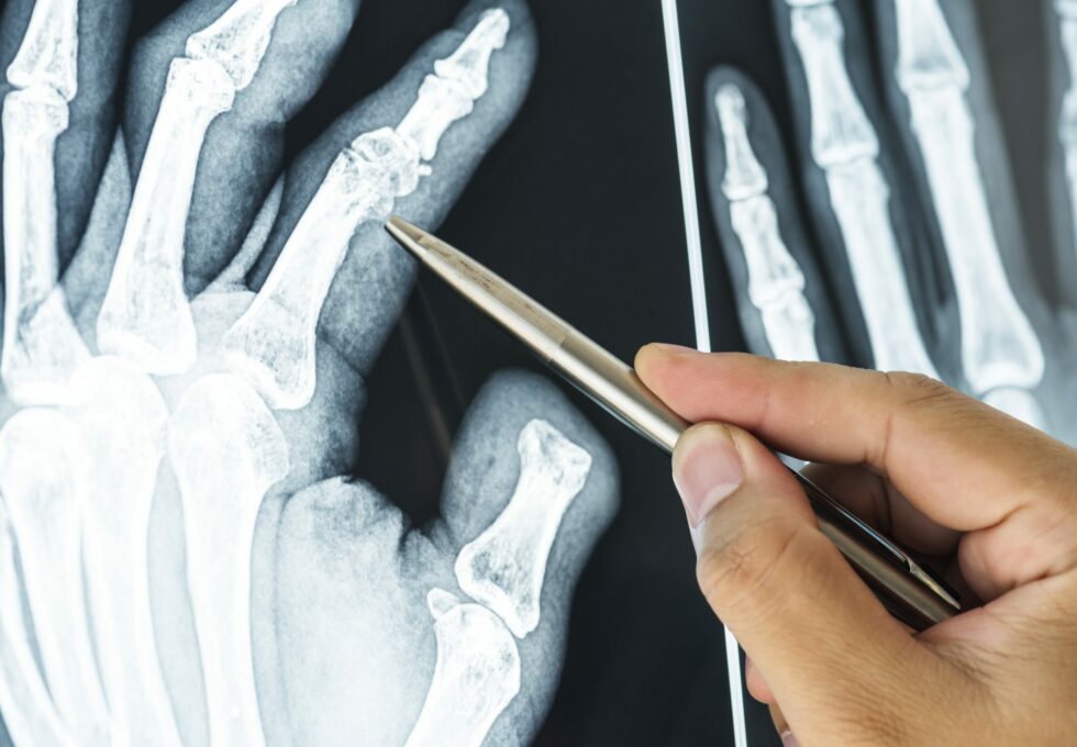 How to Heal Broken Bones and Fractures: A Guide to Aftercare | CityHealth