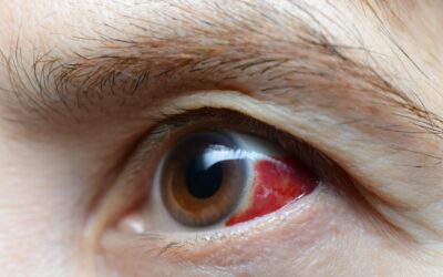 7 Common Eye Injuries