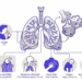 sintomas de neumonia — CityHealth
