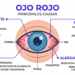 Ojo Rojo Causas: Irritación, Infección y Cuándo Debes Buscar Atención