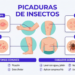 Picaduras de Insectos: Qué Puedes Hacer en Casa y Cuándo Buscar Atención Médica