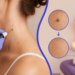 skin tag removal — CityHealth