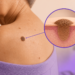 seborrheic keratosis — CityHealth