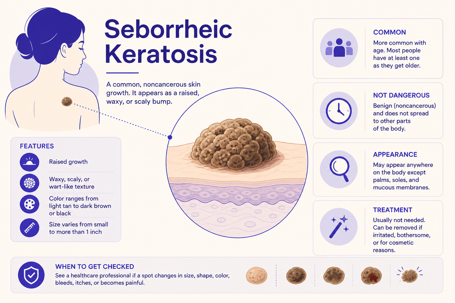 seborrheic keratosis